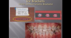 (실습 41) Ceramic Brackets의 종류와 선택