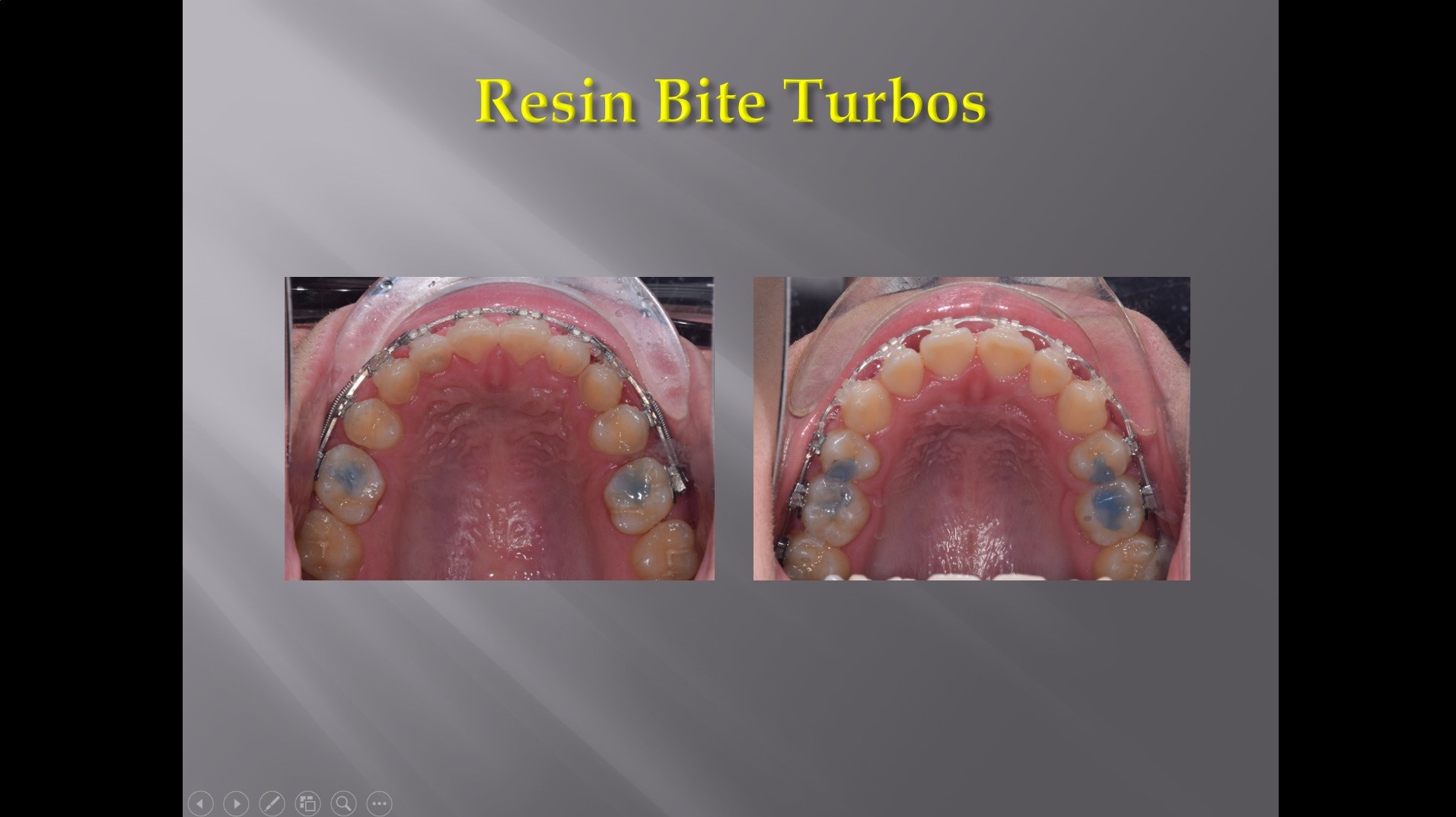 (실습 43) Resin Bite Turbos