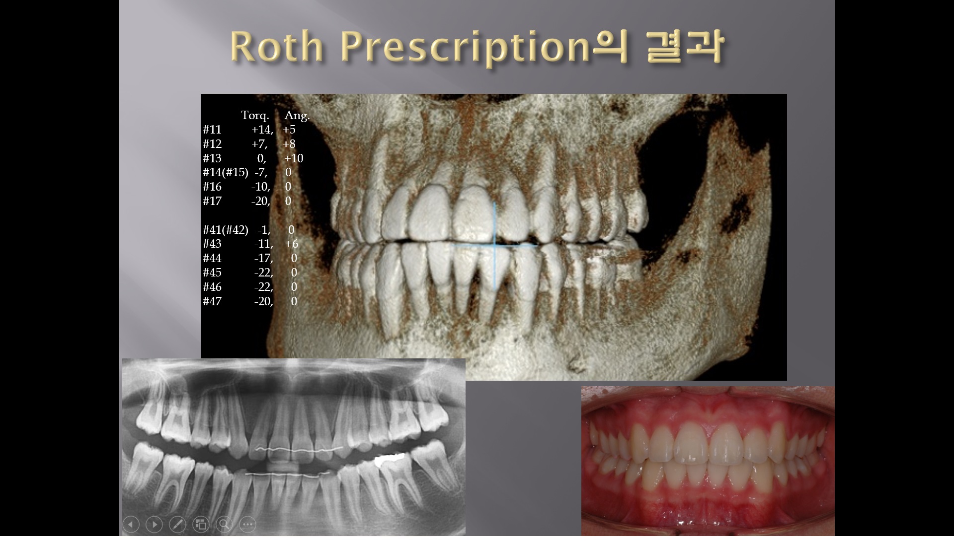 (강의 5) Sem #2 : 교정재료 2 (Brackets, Archwires, Bands, etc)