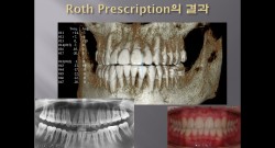 (강의 5) Sem #2 : 교정재료 2 (Brackets, Archwires, Bands, etc)