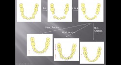 (강의 8) Sem #2 : Protrusion, Anchorage and Extraction 이해