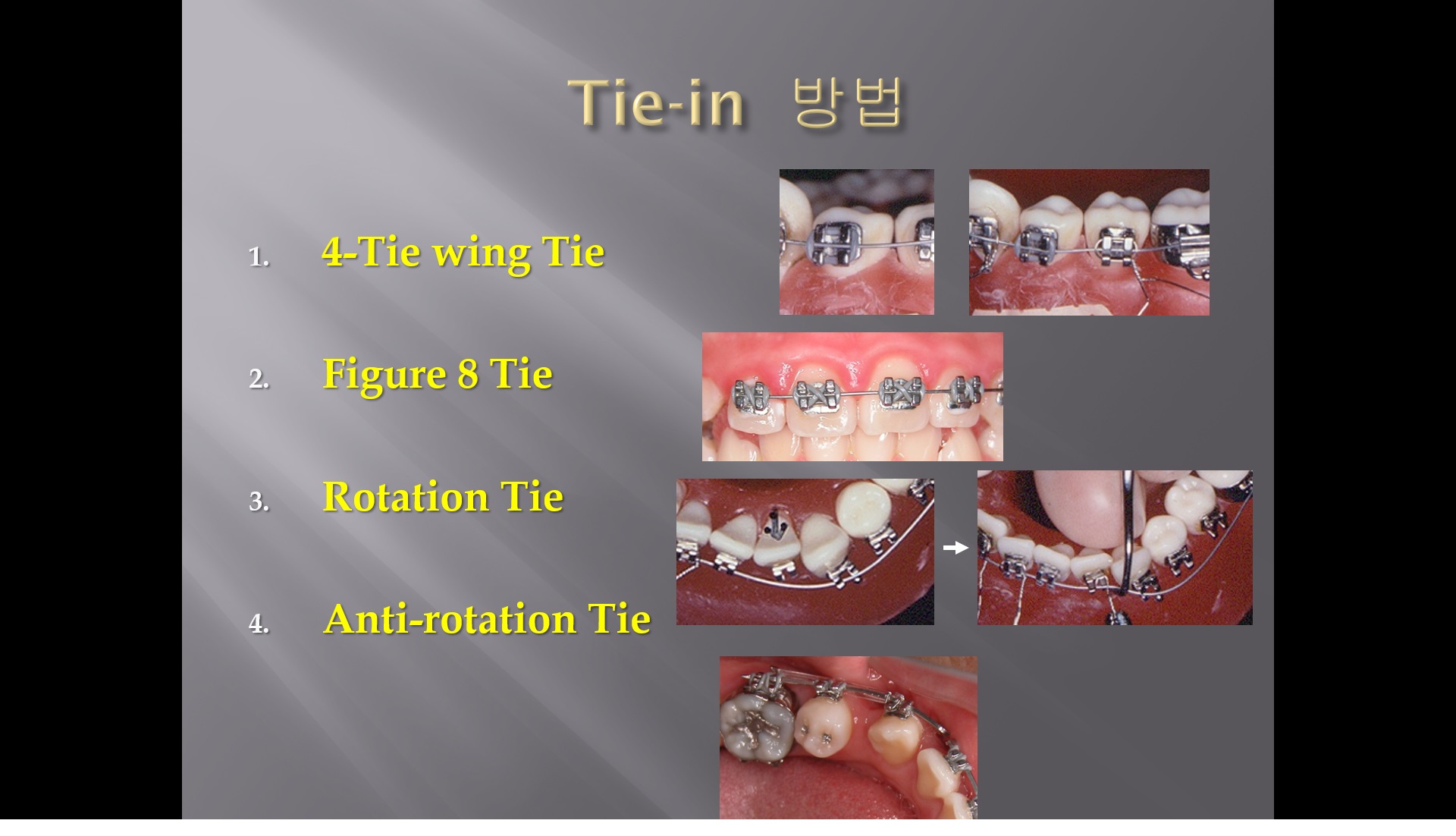 (강의 11) Sem #3 : Bracket, Band, Archwire (Part 4)