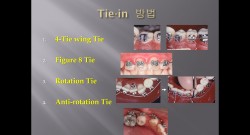 (강의 11) Sem #3 : Bracket, Band, Archwire (Part 4)