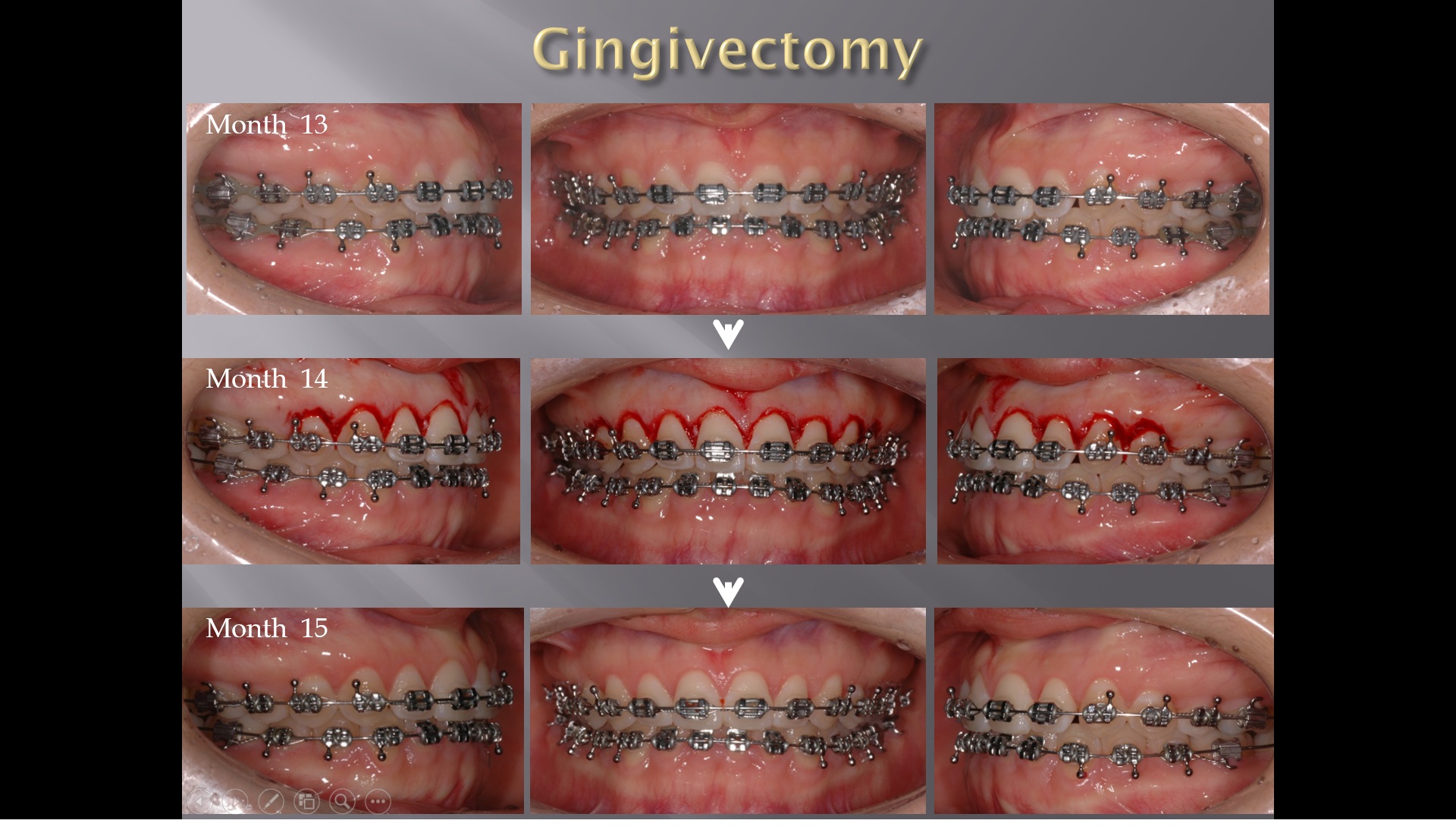 (강의 17) Sem #5 : Stripping, Gingivectomy