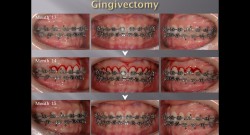 (강의 17) Sem #5 : Stripping, Gingivectomy