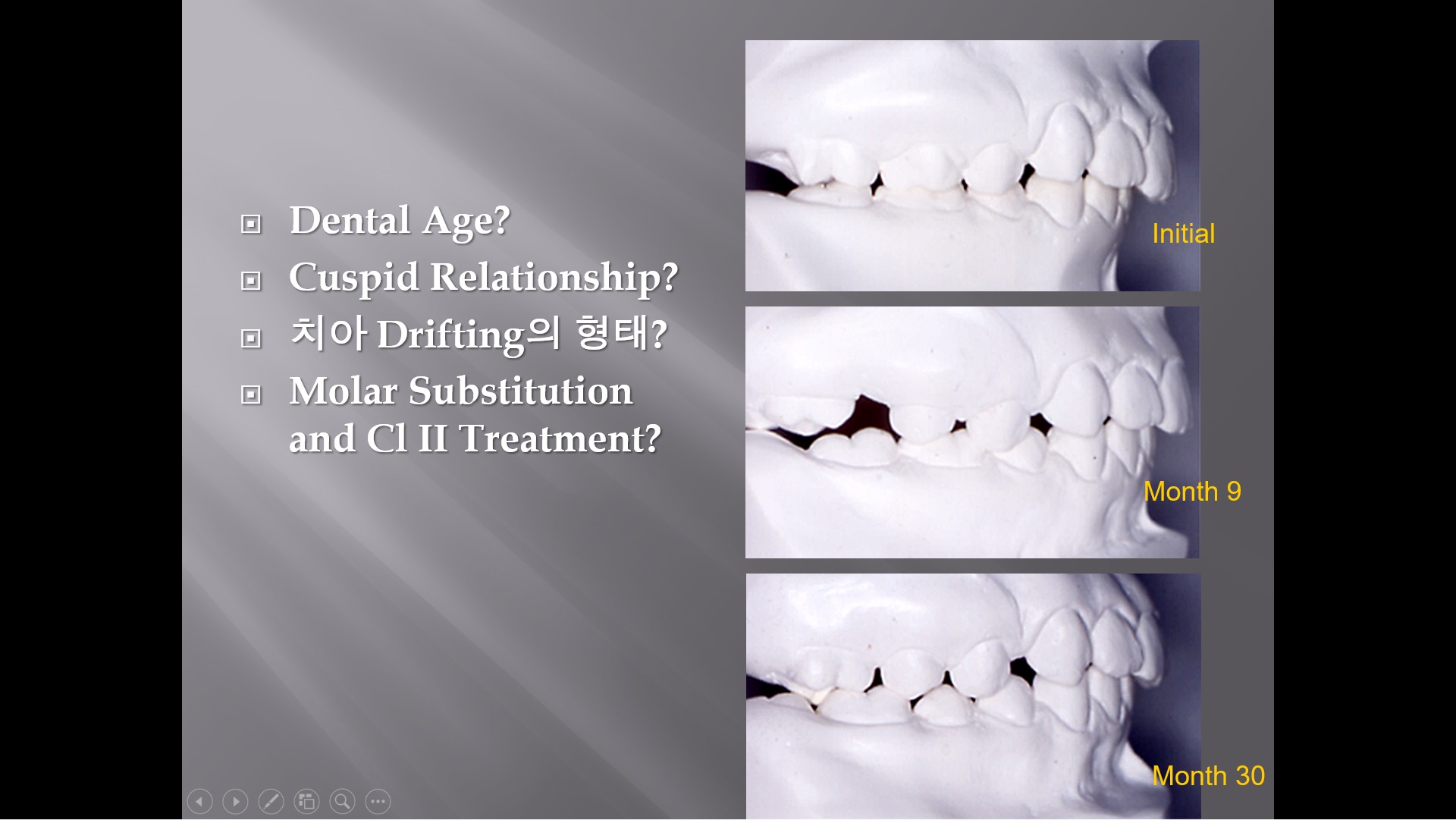 (강의 17) Sem #5 : Drifting of Teeth, Molar Substitution, DBS of #7