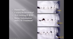 (강의 17) Sem #5 : Drifting of Teeth, Molar Substitution, DBS of #7