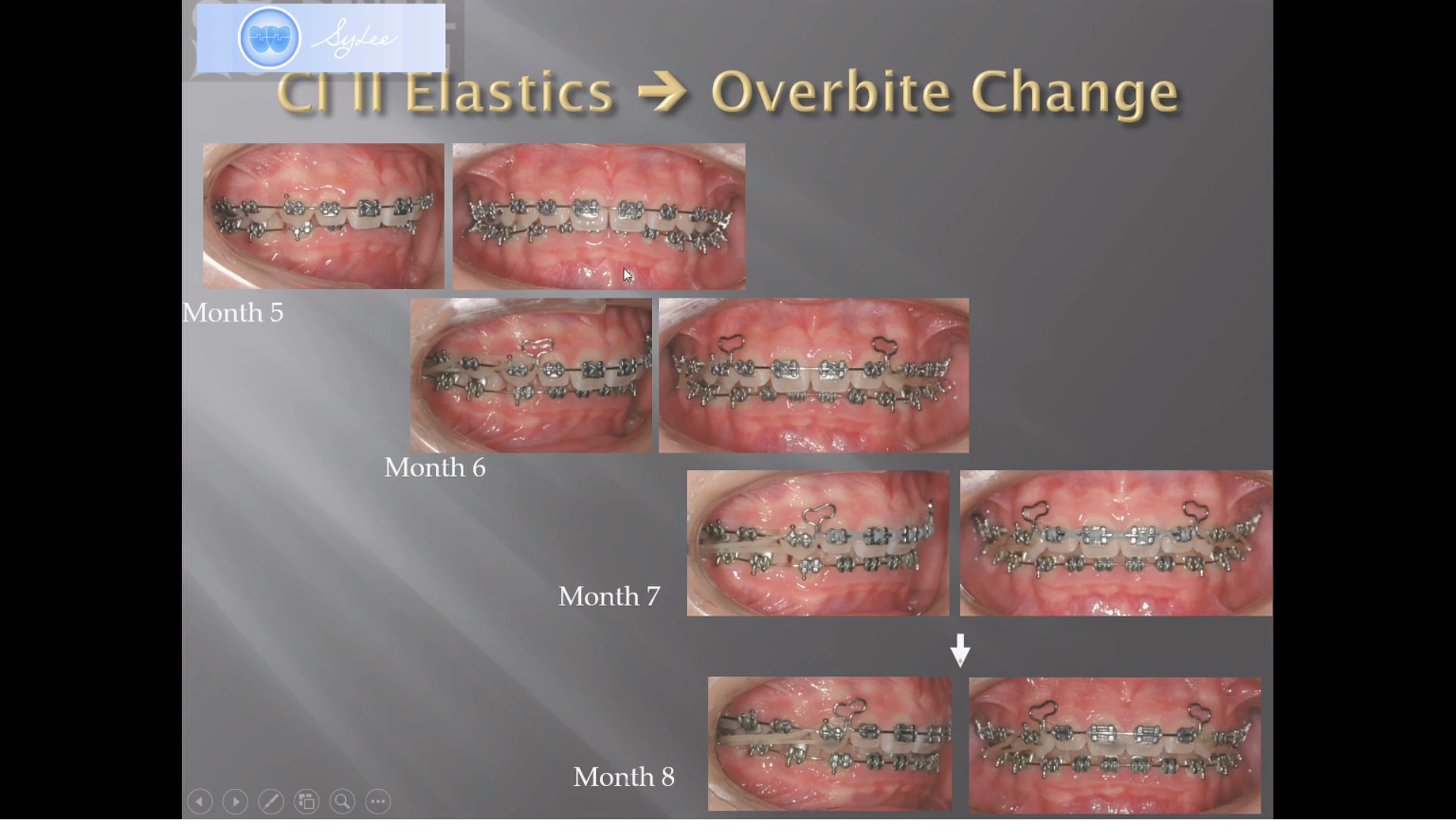 (강의 18) Sem #6 : Dental Deepbite (Part 2)