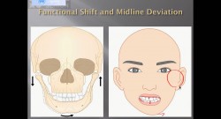 (강의 19) Sem #6 : Functional Shift와 Dental Midline (Part II)