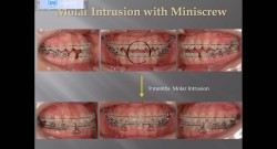 (강의 20) Sem #7 : Dental Openbite