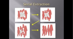 (강의 23) Sem #9 : Pedo-Ortho (Part 3)