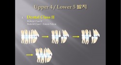 (강의 27) Sem #10 : Extraction (Part 3) - U4L5 발치