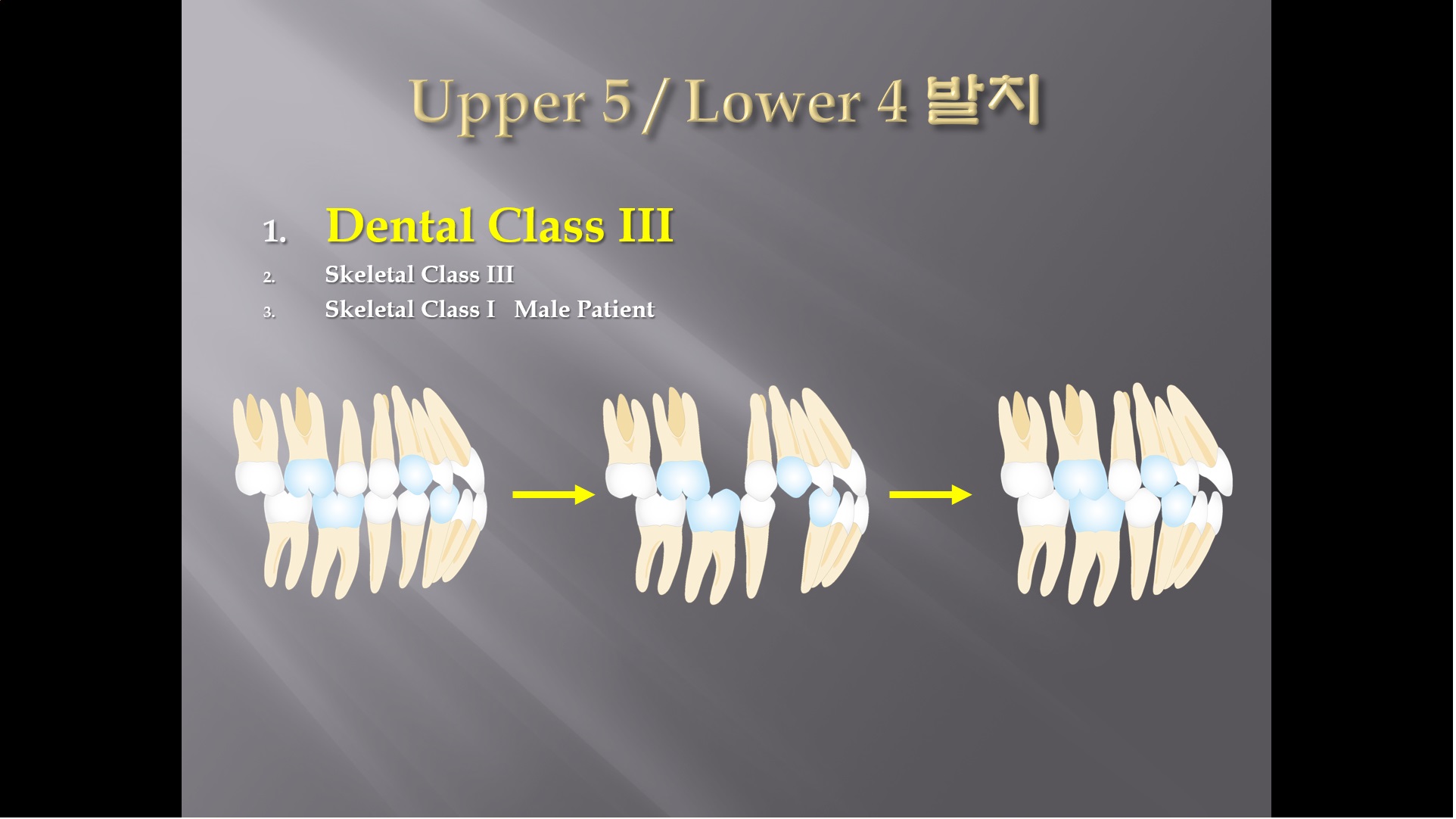 (강의 27) Sem #10 : Extraction (Part 4) - U5L4 발치