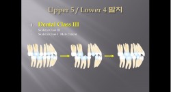 (강의 27) Sem #10 : Extraction (Part 4) - U5L4 발치