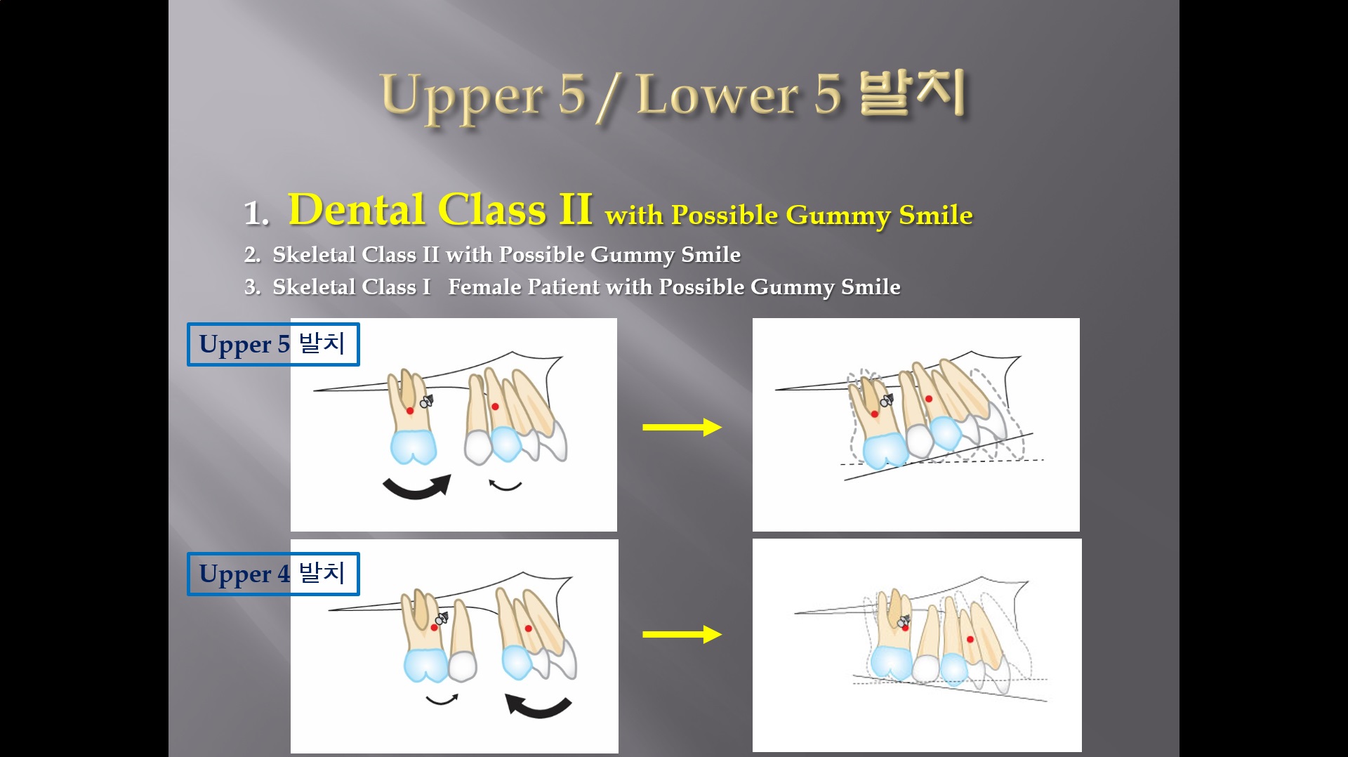 (강의 27) Sem #10 : Extraction (Part 5) - U5L5 발치