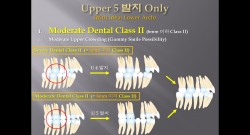 (강의 27) Sem #10 : Extraction (Part 7) - U5 발치 Only