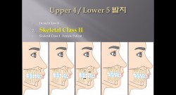 (강의 27) Sem #10 : Extraction (Part 10) - Bicuspids 발치 정리