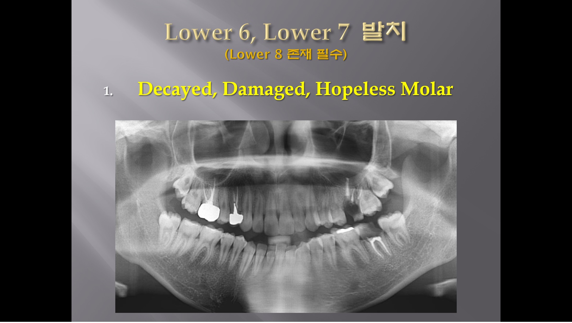 (강의 27) Sem #10 : Extraction (Part 12) - L6, L7 발치