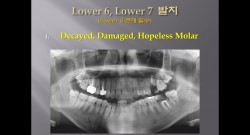 (강의 27) Sem #10 : Extraction (Part 12) - L6, L7 발치