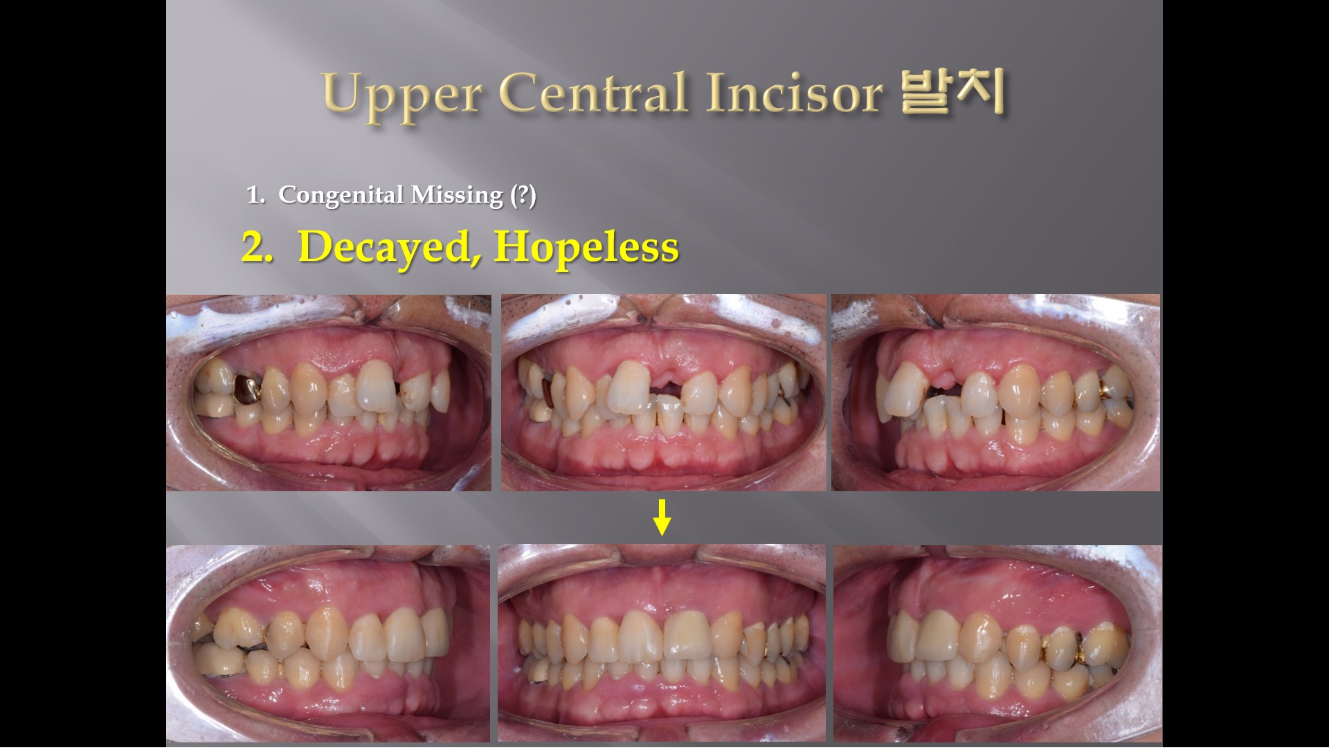 (강의 27) Sem #10 : Extraction (Part 13) - Upper Anterior Teeth 발치