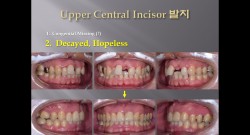 (강의 27) Sem #10 : Extraction (Part 13) - Upper Anterior Teeth 발치