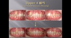 (강의 27) Sem #10 : Extraction (Part 14) - Lower Anterior Teeth 발치