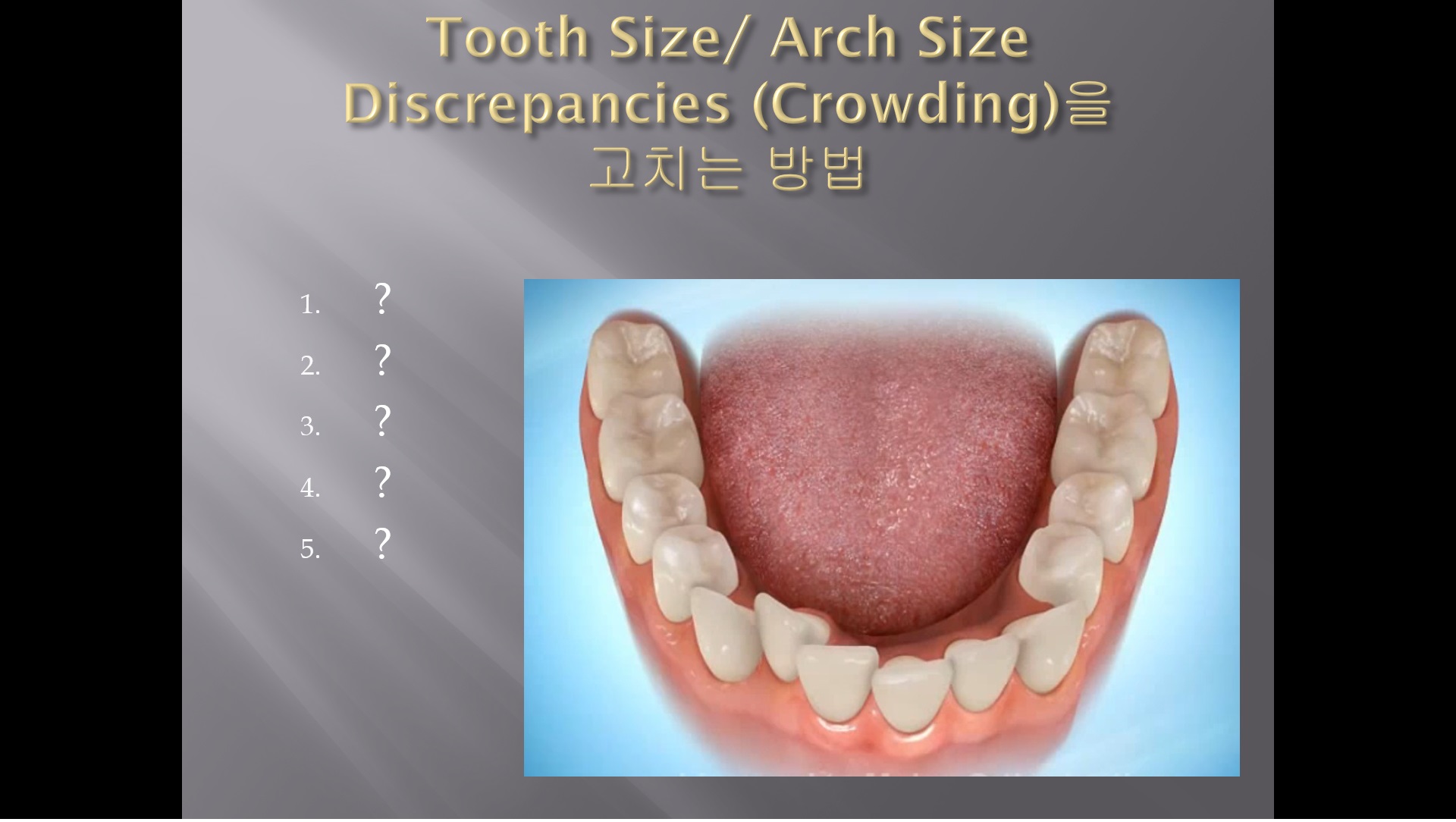 (강의 29) Sem #11 : Tooth Size and Arch Size Discrepancies (Part 1) -Expansion