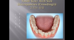 (강의 29) Sem #11 : Tooth Size and Arch Size Discrepancies (Part 1) -Expansion