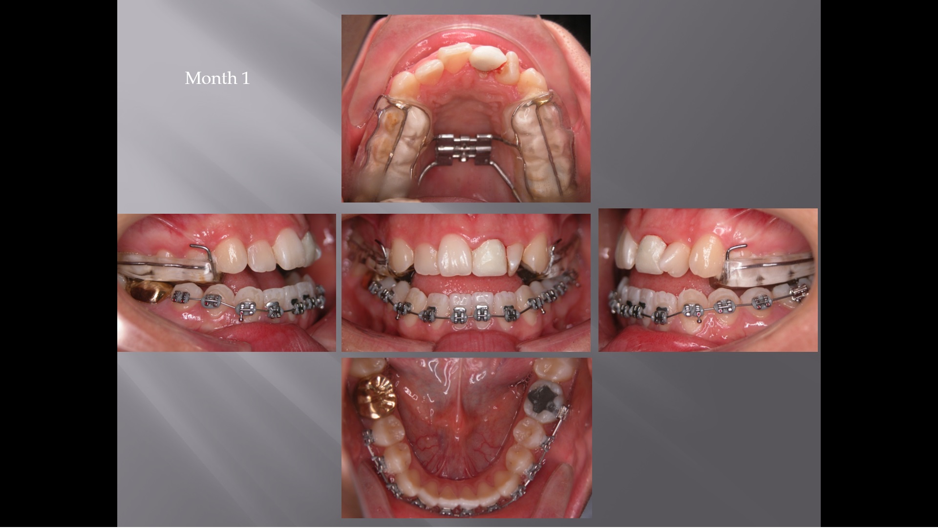 (강의 29) Sem #11 : Tooth Size and Arch Size Discrepancies (Part 2)