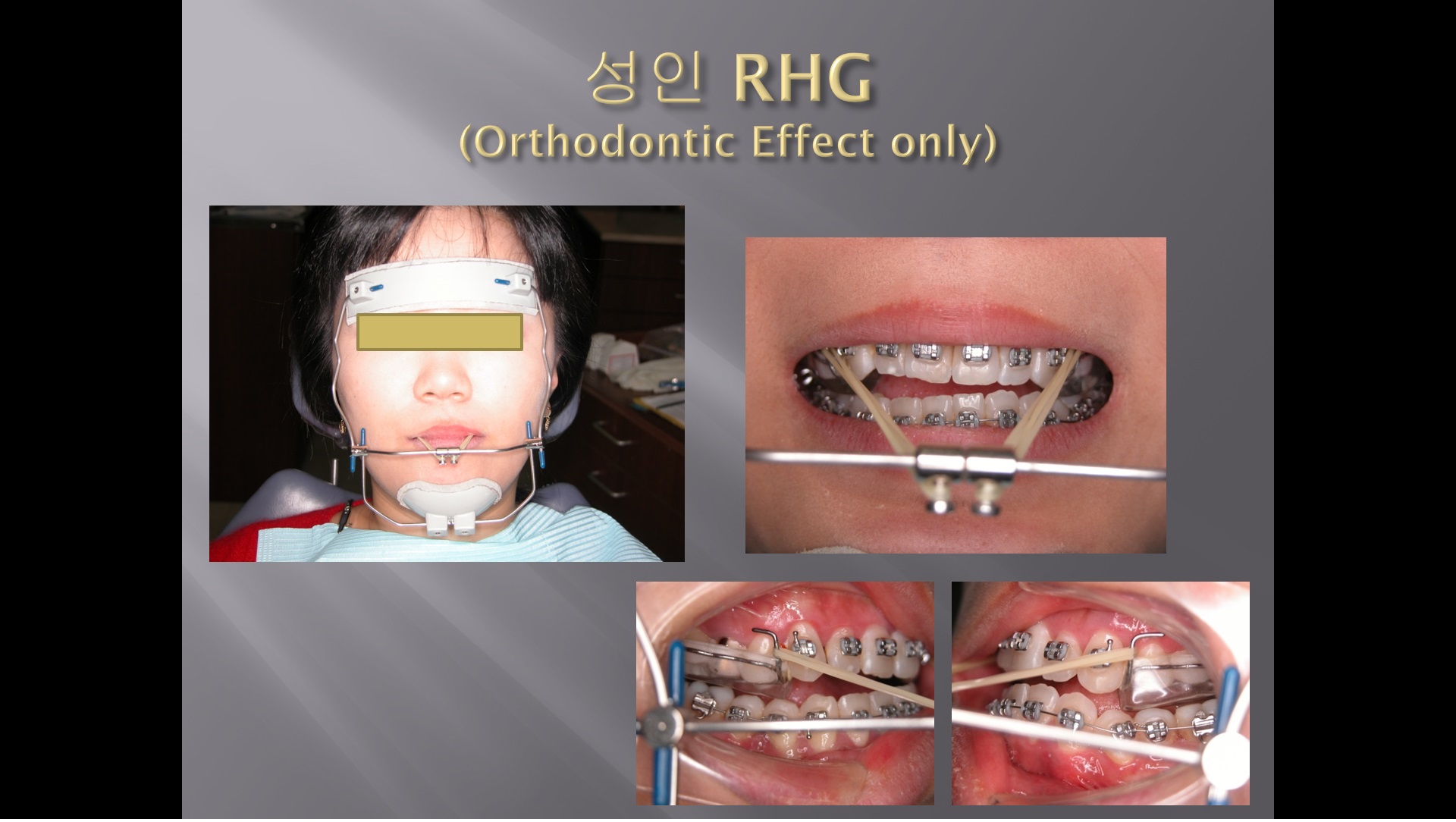 (강의 31) Sem #12 : Extraoral traction (Part 3)