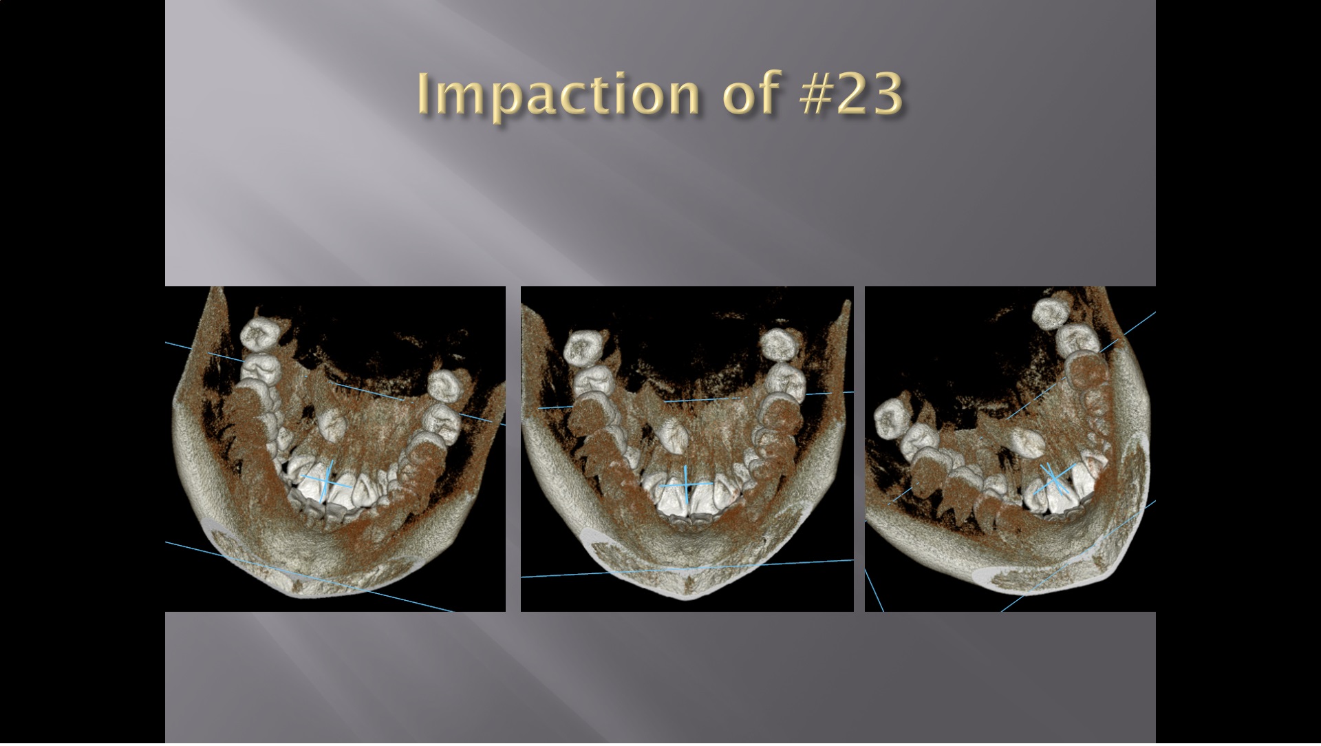 (강의 34) Sem #14 : Retrieval of Impacted Teeth (Part 1)