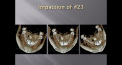 (강의 34) Sem #14 : Retrieval of Impacted Teeth (Part 1)