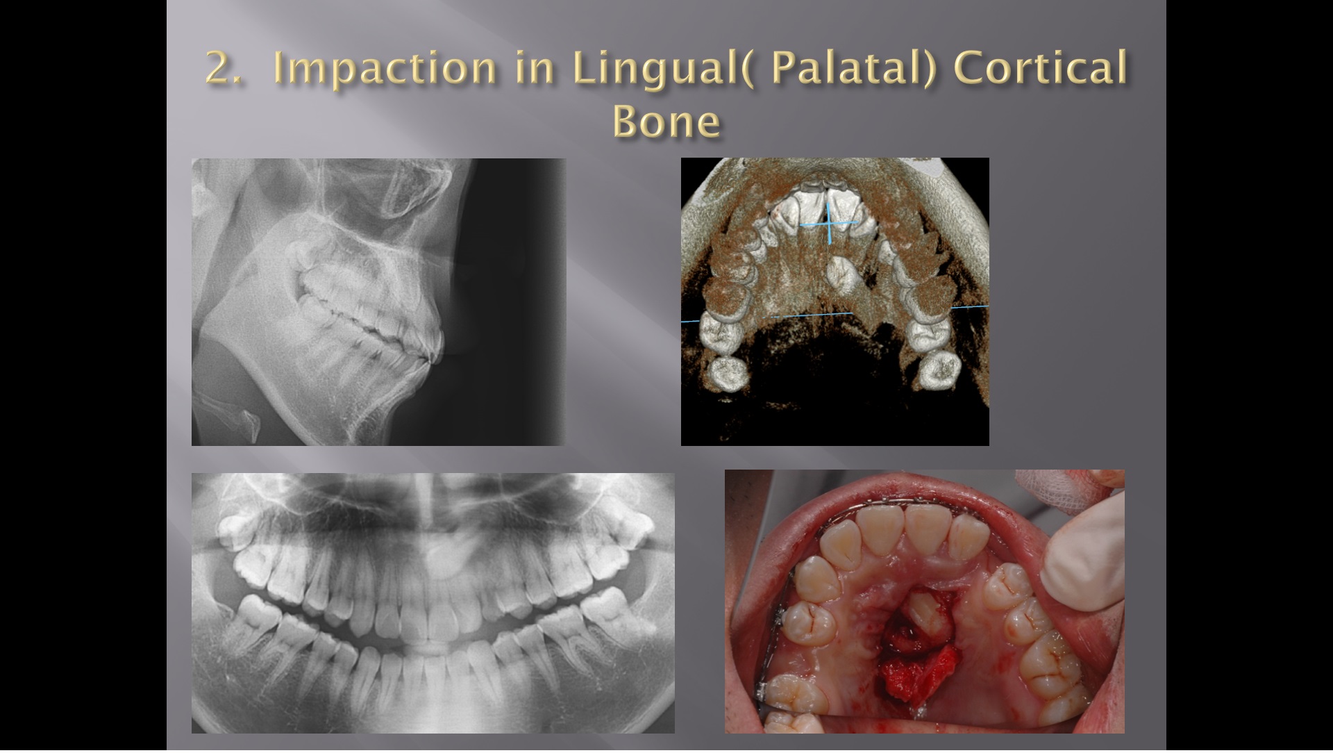 (강의 34) Sem #14 : Retrieval of Impacted Teeth (Part 2)