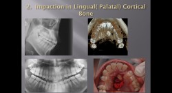 (강의 34) Sem #14 : Retrieval of Impacted Teeth (Part 2)