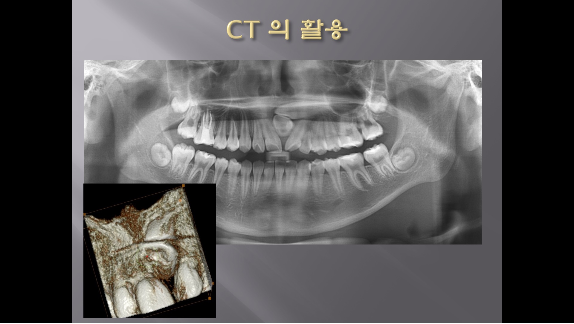 (강의 34) Sem #14 : Retrieval of Impacted Teeth (Part 3)