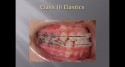 (강의 40) Sem #16 : Cl III. (Part II.  Treatment Methods)