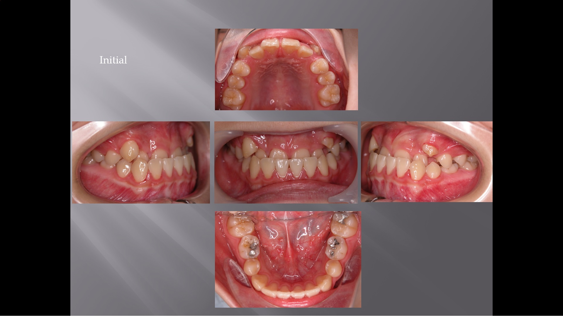 (강의 40) Sem #16 : Cl III. (Part III. Treatment Plans.  Ext. vs Nonext.)