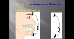 (강의 40) Sem #16 : Cl III. (Part IV. Treatment Plans.  4 Dimensions)