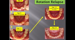 (강의 49) Sem #18 : Retention and Relapse (Part I)-Relapse Examples