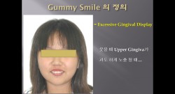 (강의 90) Sem #7.5 : Gummy Smile (Part 1-1)