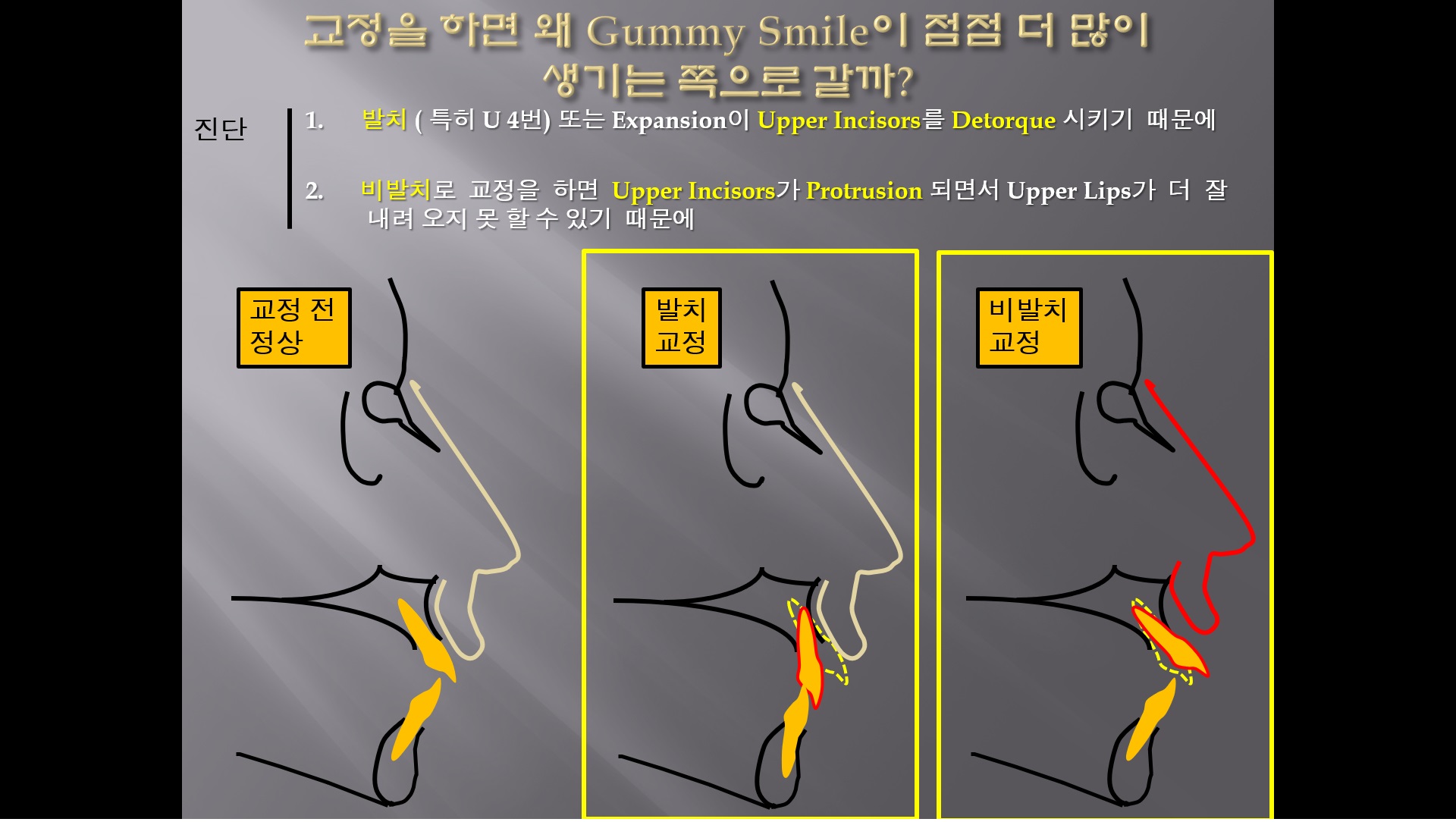 (강의 90) Sem #7.5 : Gummy Smile (Part 2) - Orthodontic Reason으로 생기는 Gummy Smile