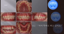 교정 Case 862.  U5L4 발치, Anterior Crossbite, Lower Crowding, Sem #12.3