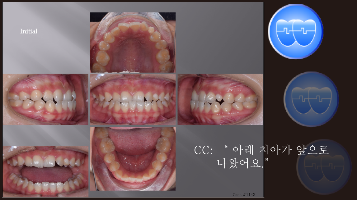 교정 Case 1143.  #13, #23 Congenital Missing, Anterior Teeth Extraction, Sem #13