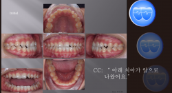 교정 Case 1143.  #13, #23 Congenital Missing, Anterior Teeth Extraction, Sem #13