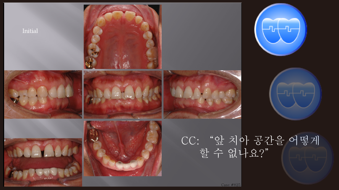 교정 Case 825.  부분교정, 성인, Upper Anterior Space Closure, Sem #20.5