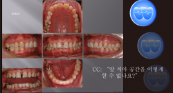 교정 Case 825.  부분교정, 성인, Upper Anterior Space Closure, Sem #20.5