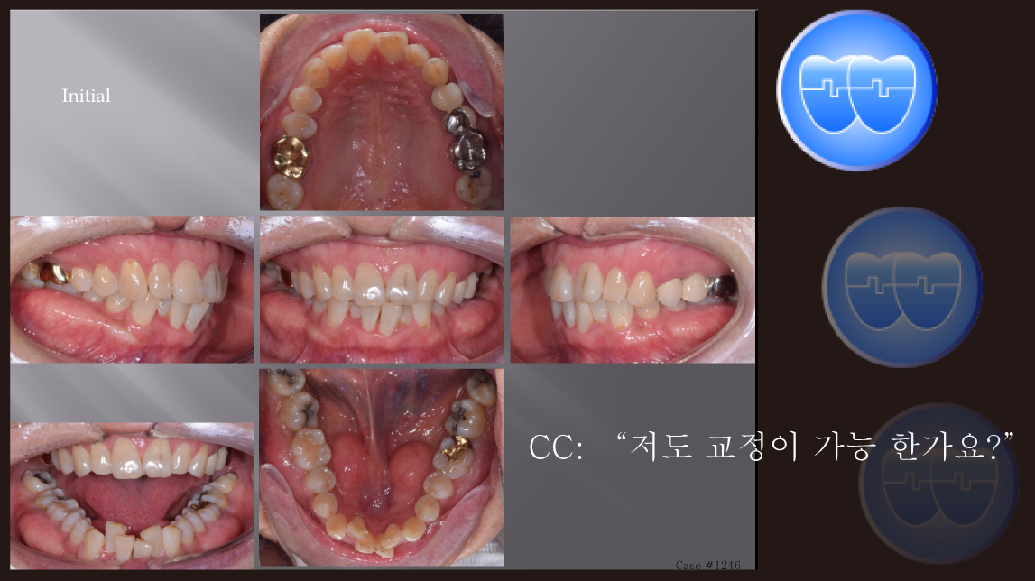 교정 Case 1246.  L1 발치, Lower Crowding, 성인교정, 부분교정, Sem #13