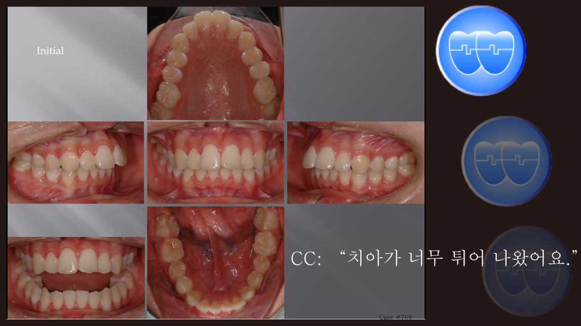 교정 Case 768.  U5 발치, Severe Overjet, Dental Midline, Vertical Grower, Sem #12.6