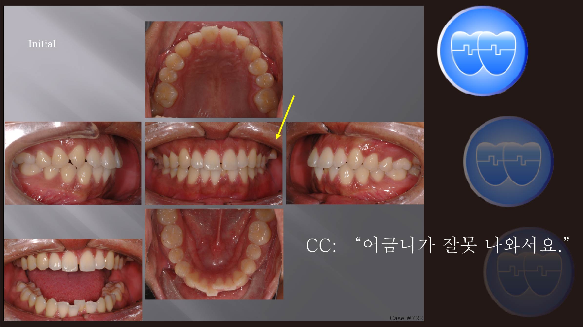 교정 Case 722.  비발치, Bilateral Posterior Scissor bite, Sem #7.8