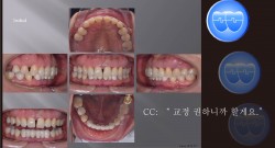 교정 Case 1177.  비발치, 부분교정, Prosth-Ortho., Perio-Ortho., Sem #20.5